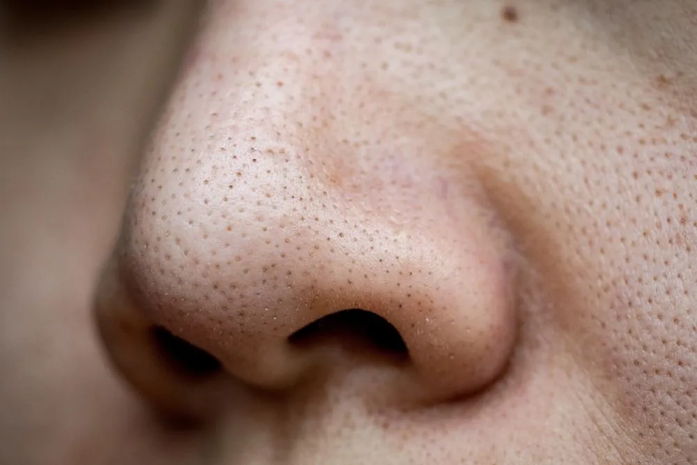 Hauptursachen vergrößerter Poren