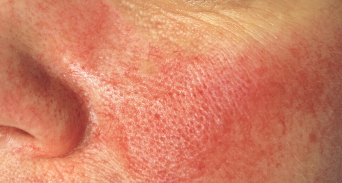 Rosacea