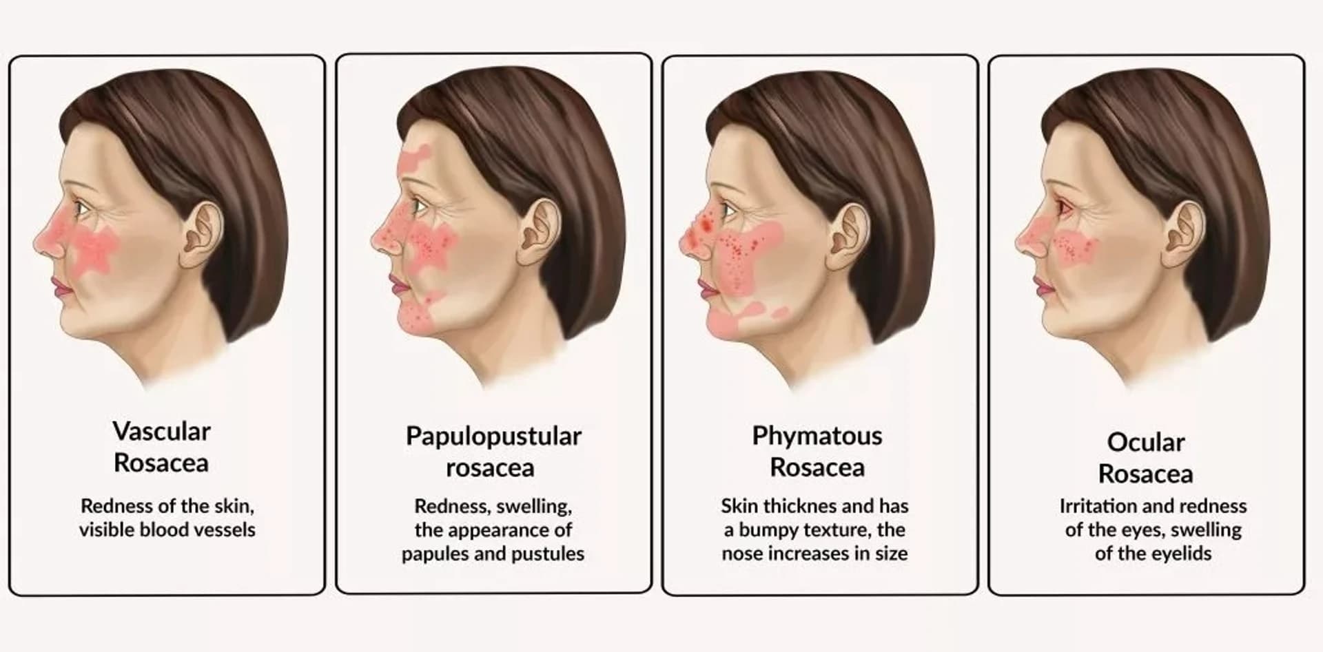 Rosazea und ihre Auslöser: ein ausführlicher Leitfaden