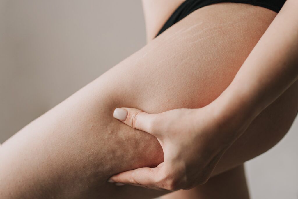 Ätiologie der Cellulite. Warum entsteht Cellulite?