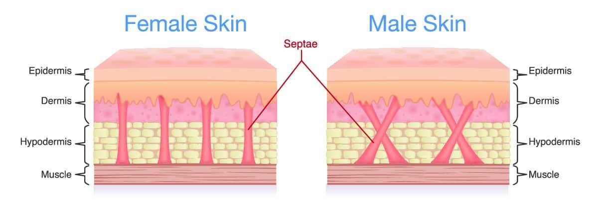 Ätiologie der Cellulite. Warum entsteht Cellulite?