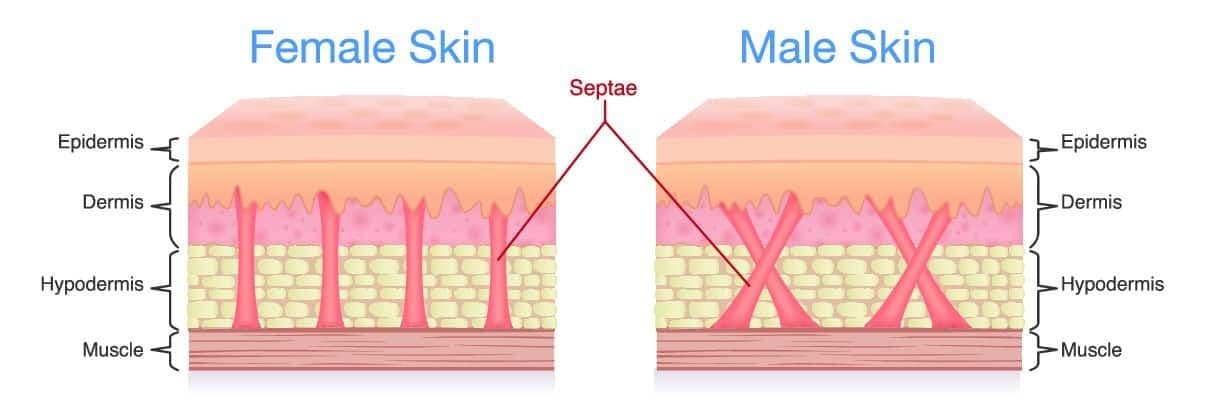 Ätiologie der Cellulite. Warum entsteht Cellulite?