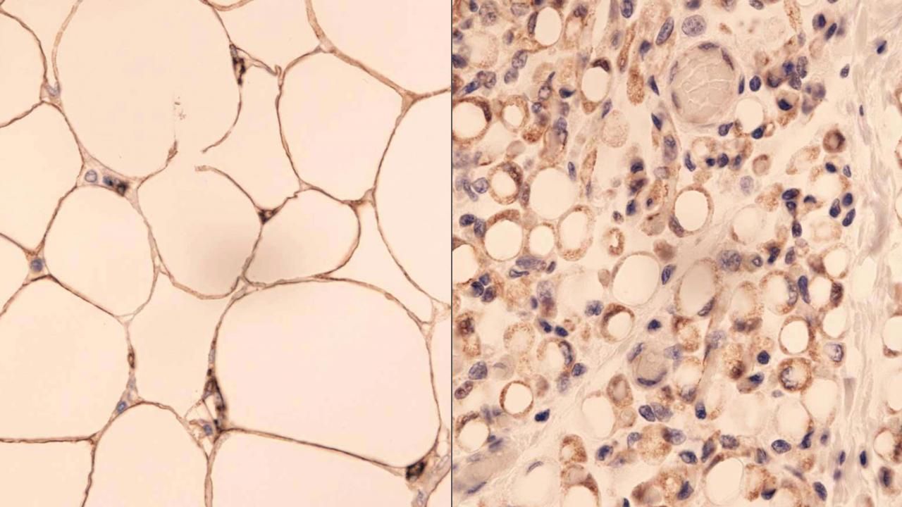 Ätiologie der Cellulite. Warum entsteht Cellulite?