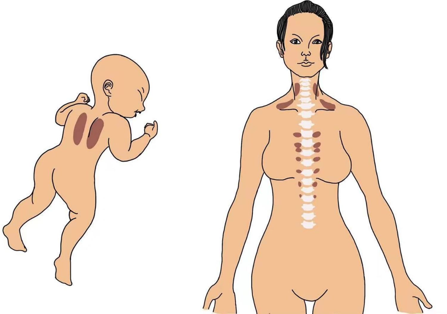 Ätiologie der Cellulite. Warum entsteht Cellulite?
