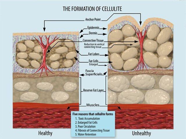Ätiologie der Cellulite. Warum entsteht Cellulite?