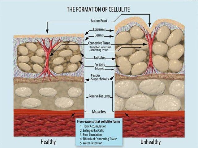 Ätiologie der Cellulite. Warum entsteht Cellulite?