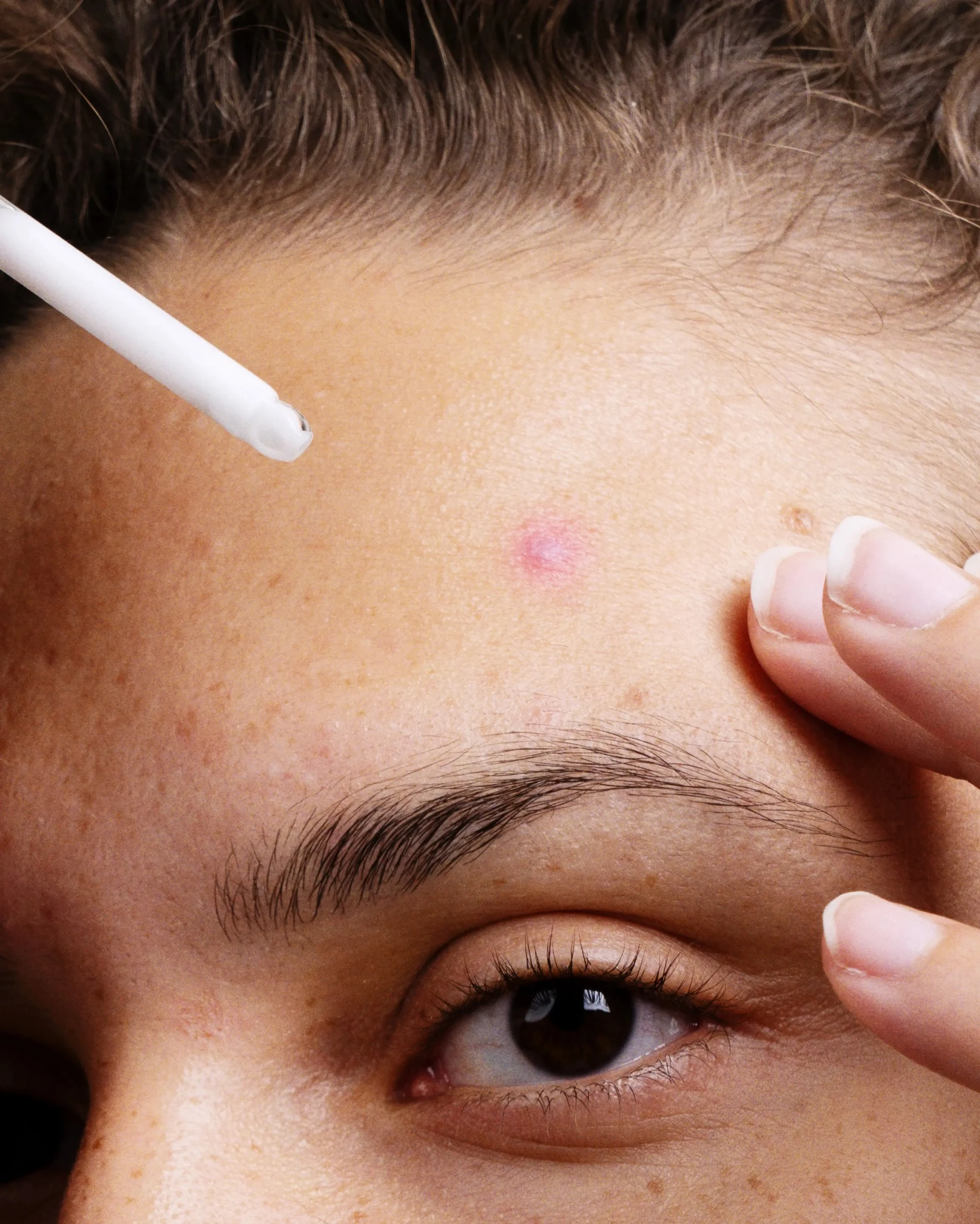 Hilft Niacinamid gegen Akne?