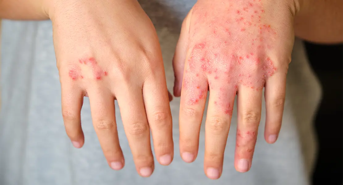 Dyshidrotisches Ekzem — Dermatitis der Hände und Füße