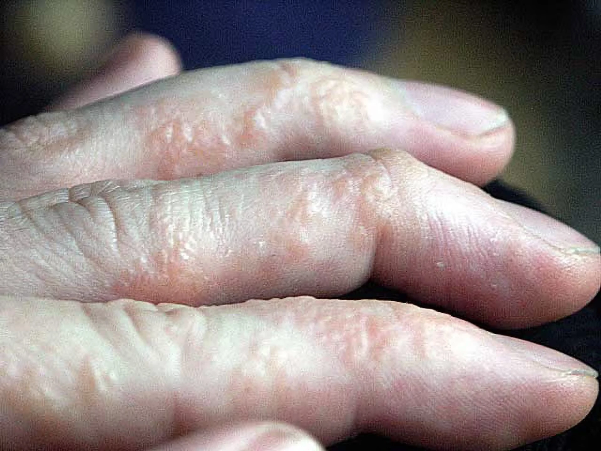 Dyshidrotisches Ekzem — Dermatitis der Hände und Füße