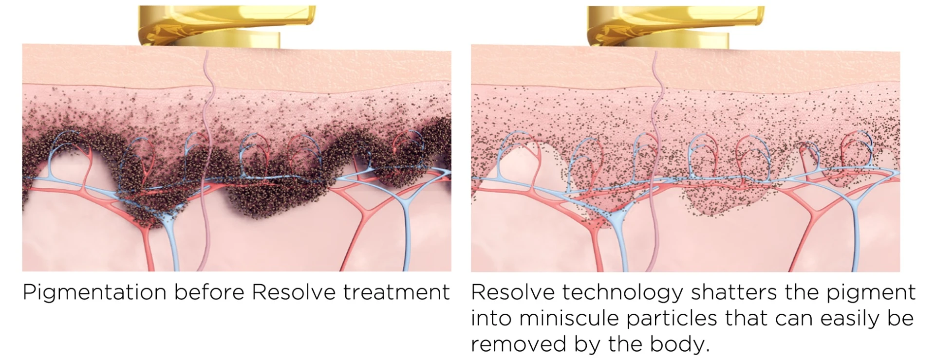 Wie behandelt man Altersflecken an den Händen?