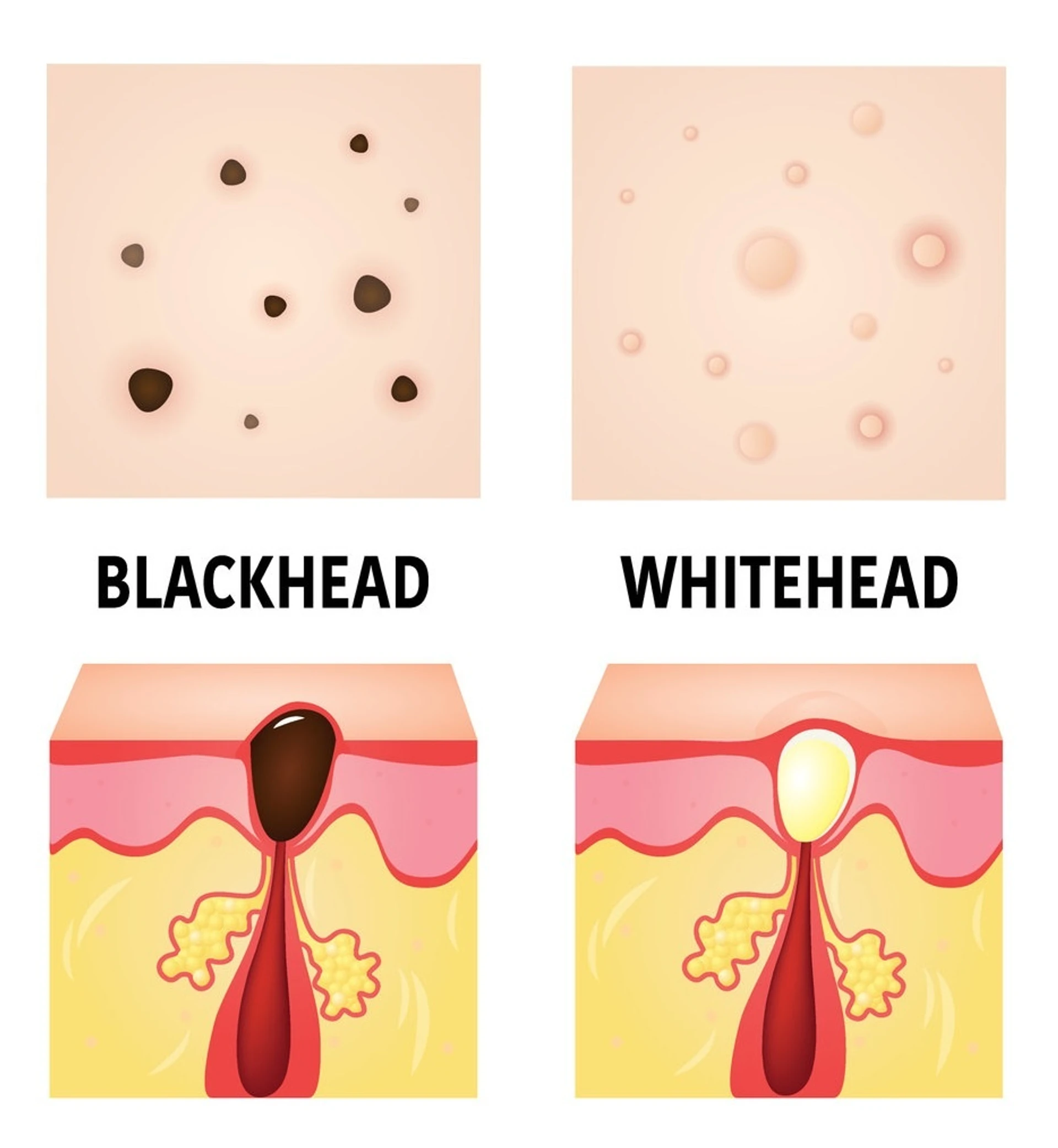 Komedonen: offen und geschlossen