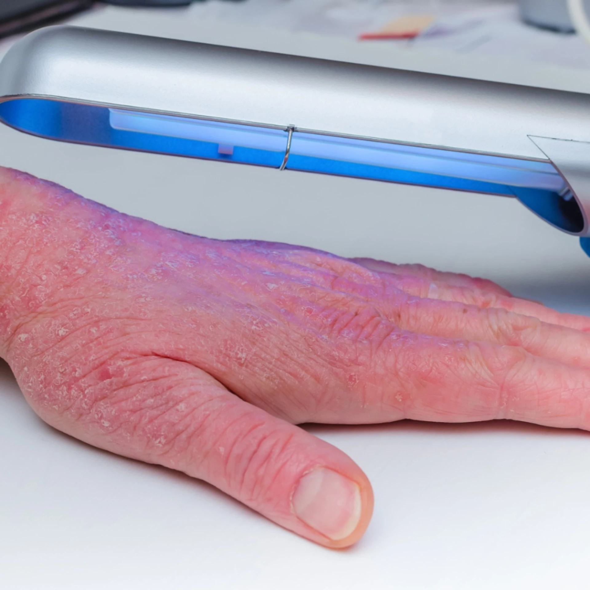 Alternative Ansätze zur Behandlung chronischen Handekzems