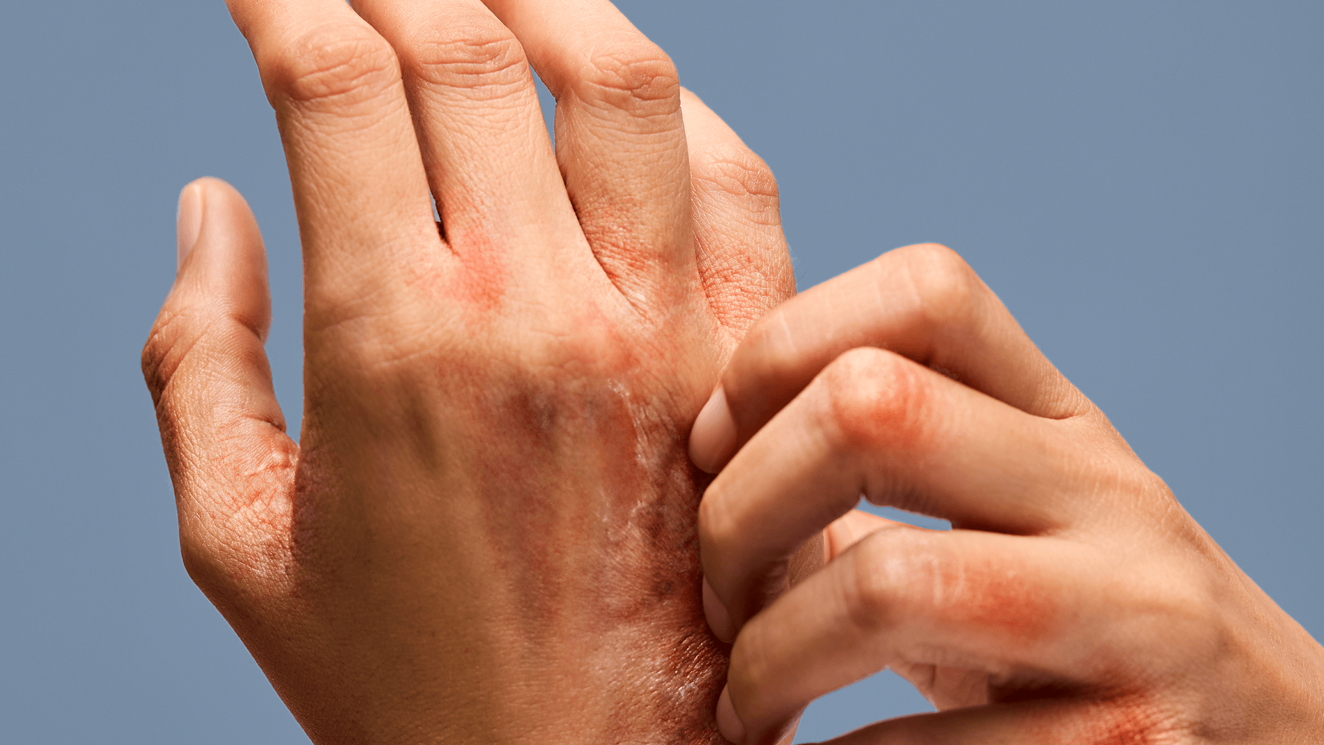 Alternative Ansätze zur Behandlung chronischen Handekzems