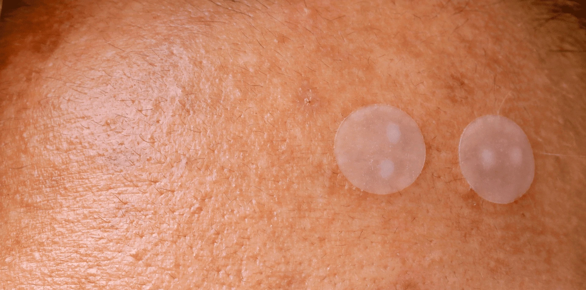 Pickel-Patches – wie wirksam sind Akne-Aufkleber?