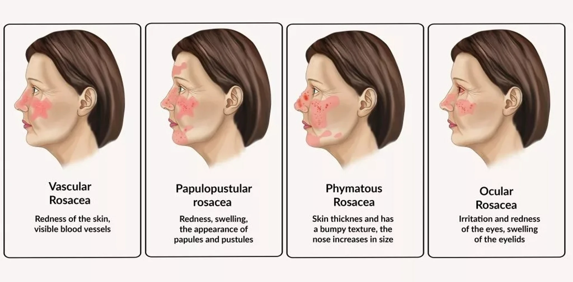 Rosazea und ihre Auslöser: ein ausführlicher Leitfaden
