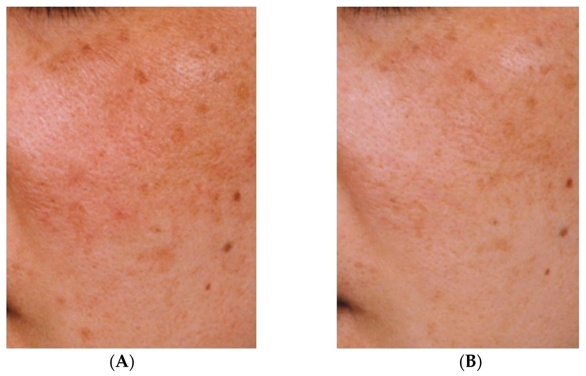 Tranexamsäure: ein wirksames Mittel im Kampf gegen Hyperpigmentierung