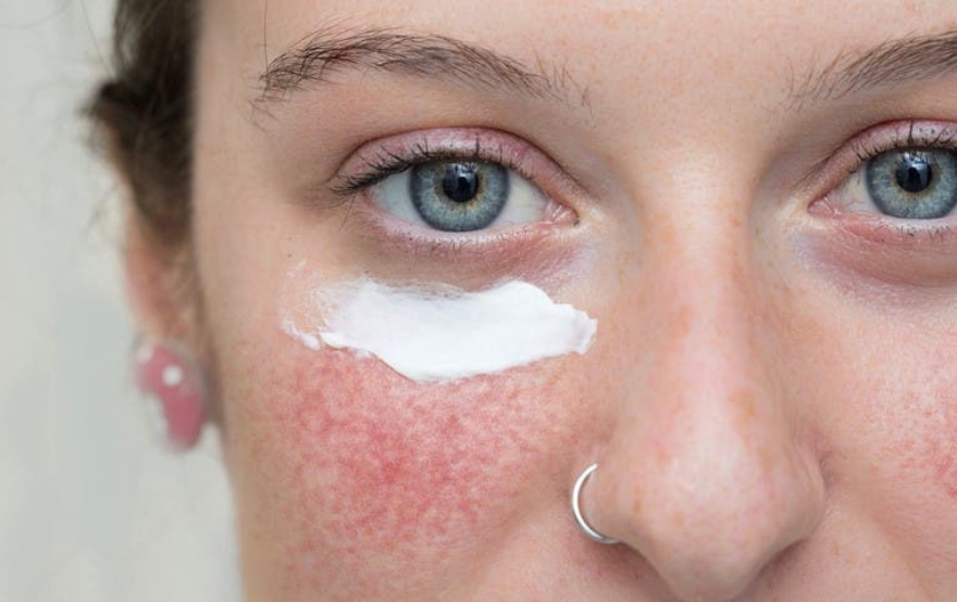 Vorteile von Azelainsäure bei Rosacea