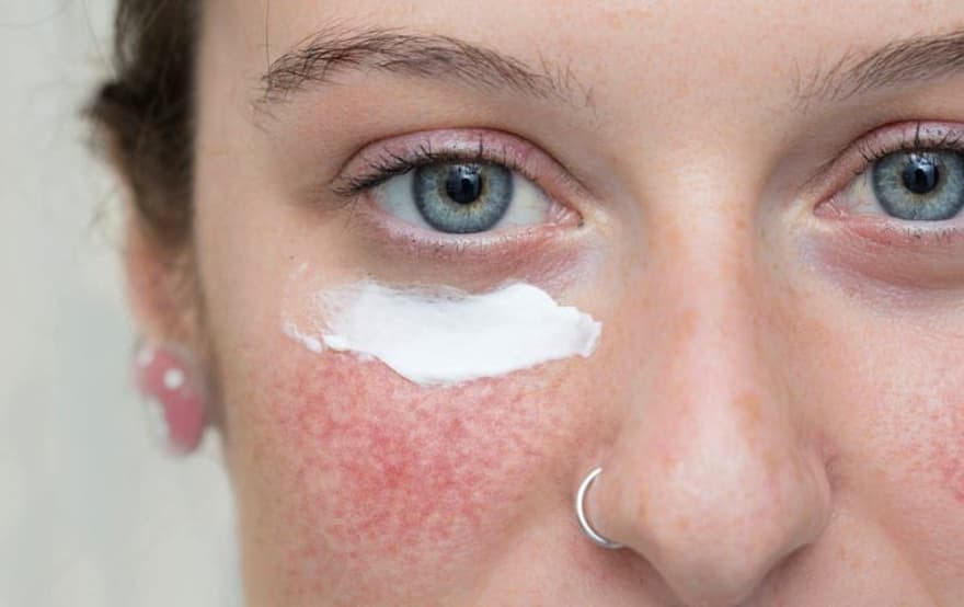 Vorteile von Azelainsäure bei Rosacea