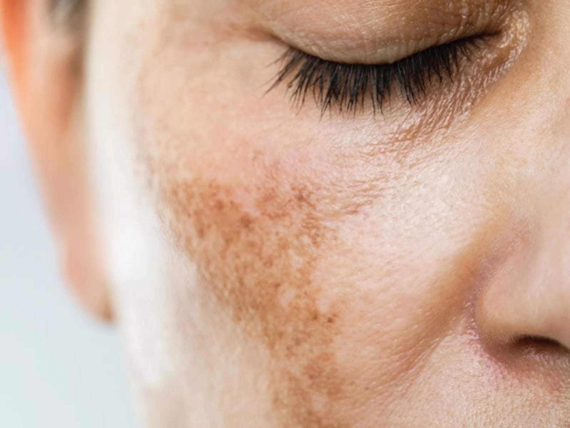 Top 9 Inhaltsstoffe zur Reduzierung von Pigmentflecken