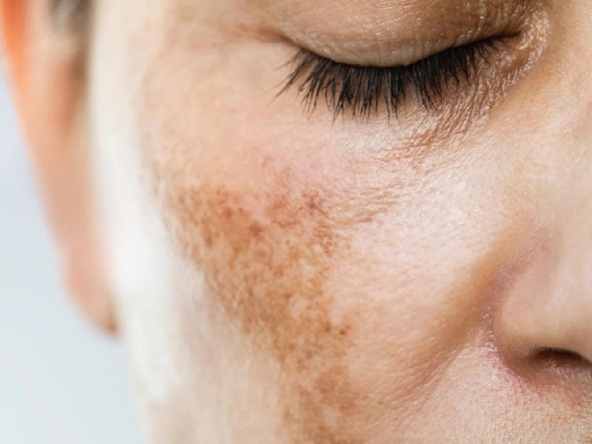 Top 9 Inhaltsstoffe zur Reduzierung von Pigmentflecken