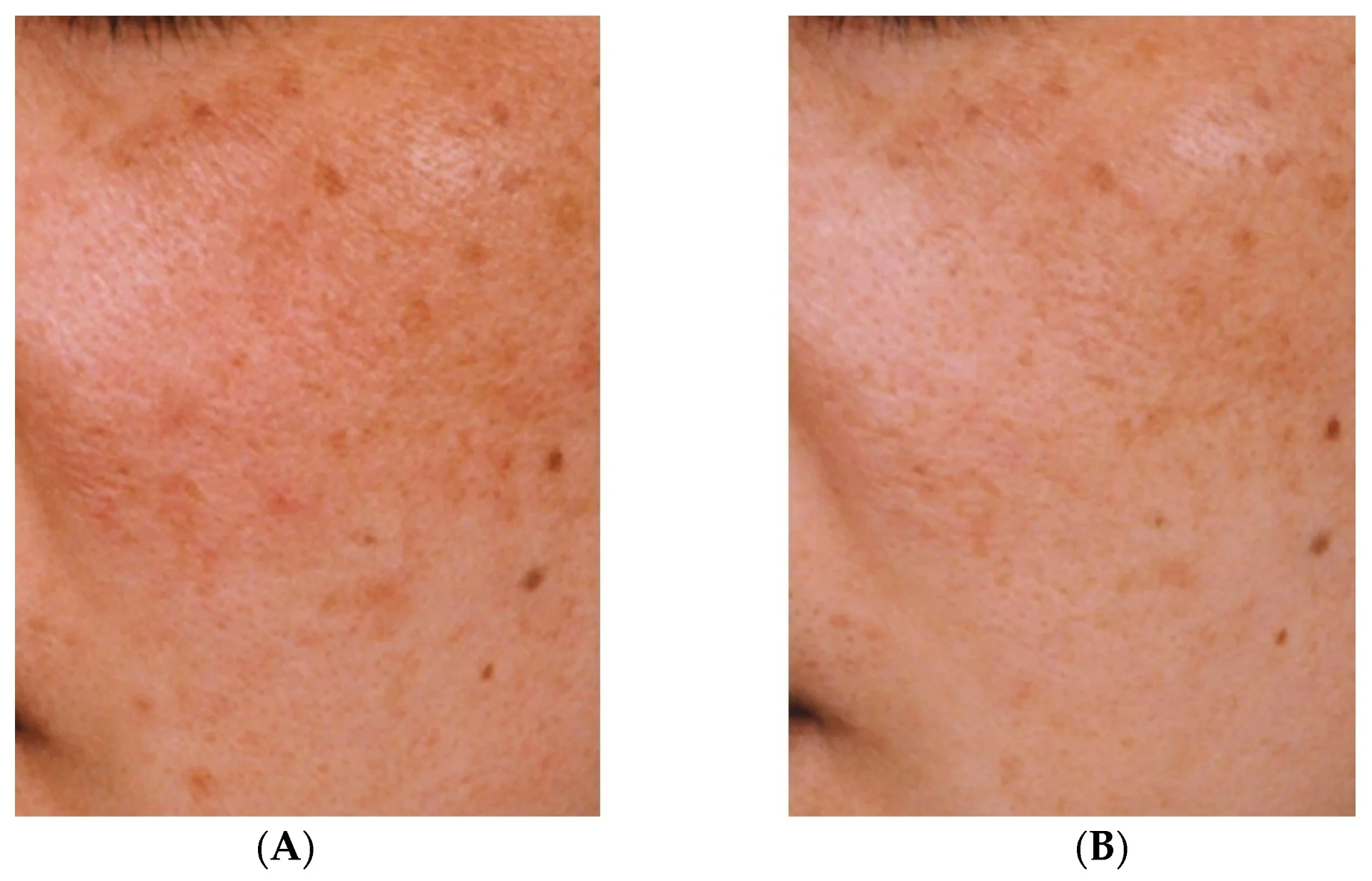 Tranexamsäure gegen Melasma: Vorteile und Nebenwirkungen