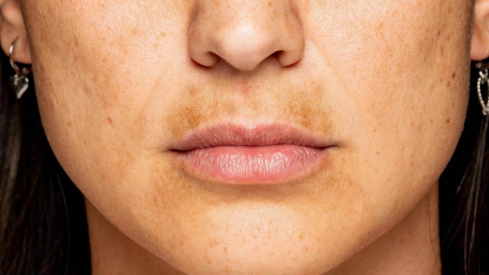 Tranexamsäure gegen Melasma: Vorteile und Nebenwirkungen