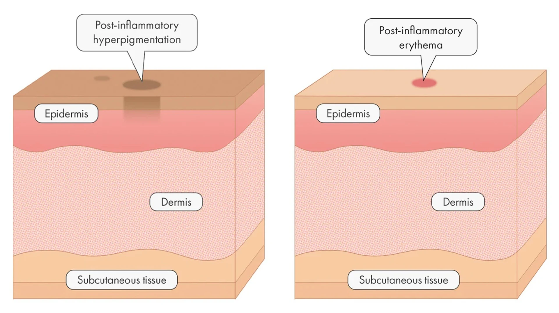 Tranexamsäure gegen Melasma: Vorteile und Nebenwirkungen