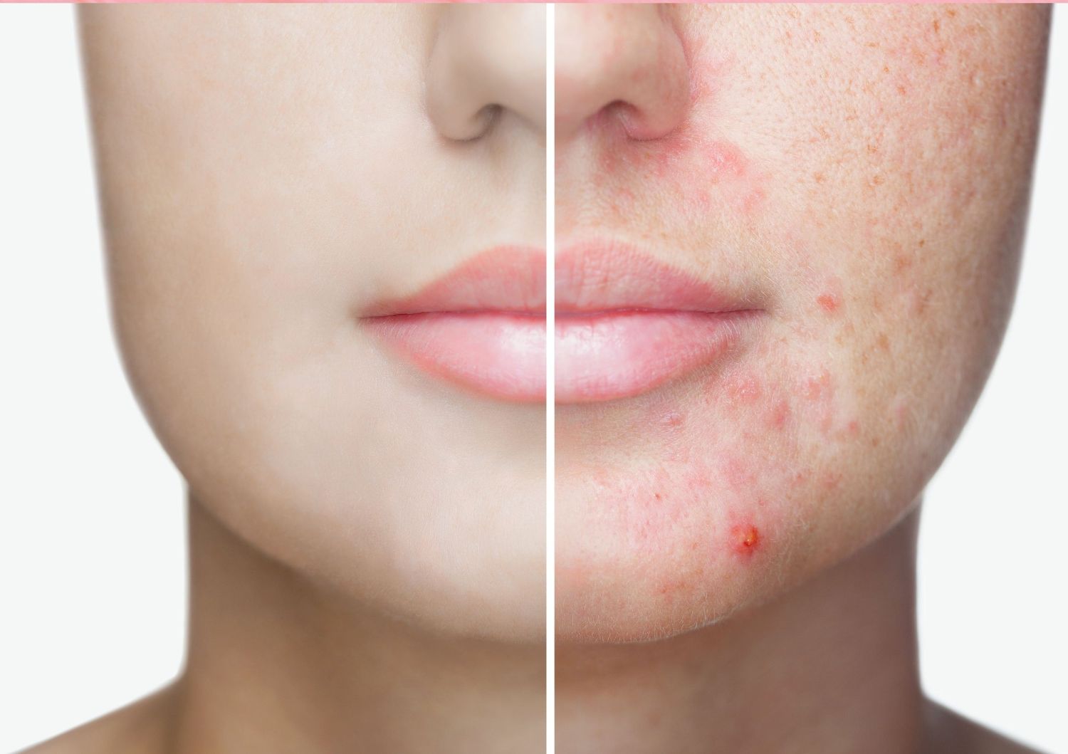 Komedogenität in der Kosmetik: Sollte man sich Sorgen machen?