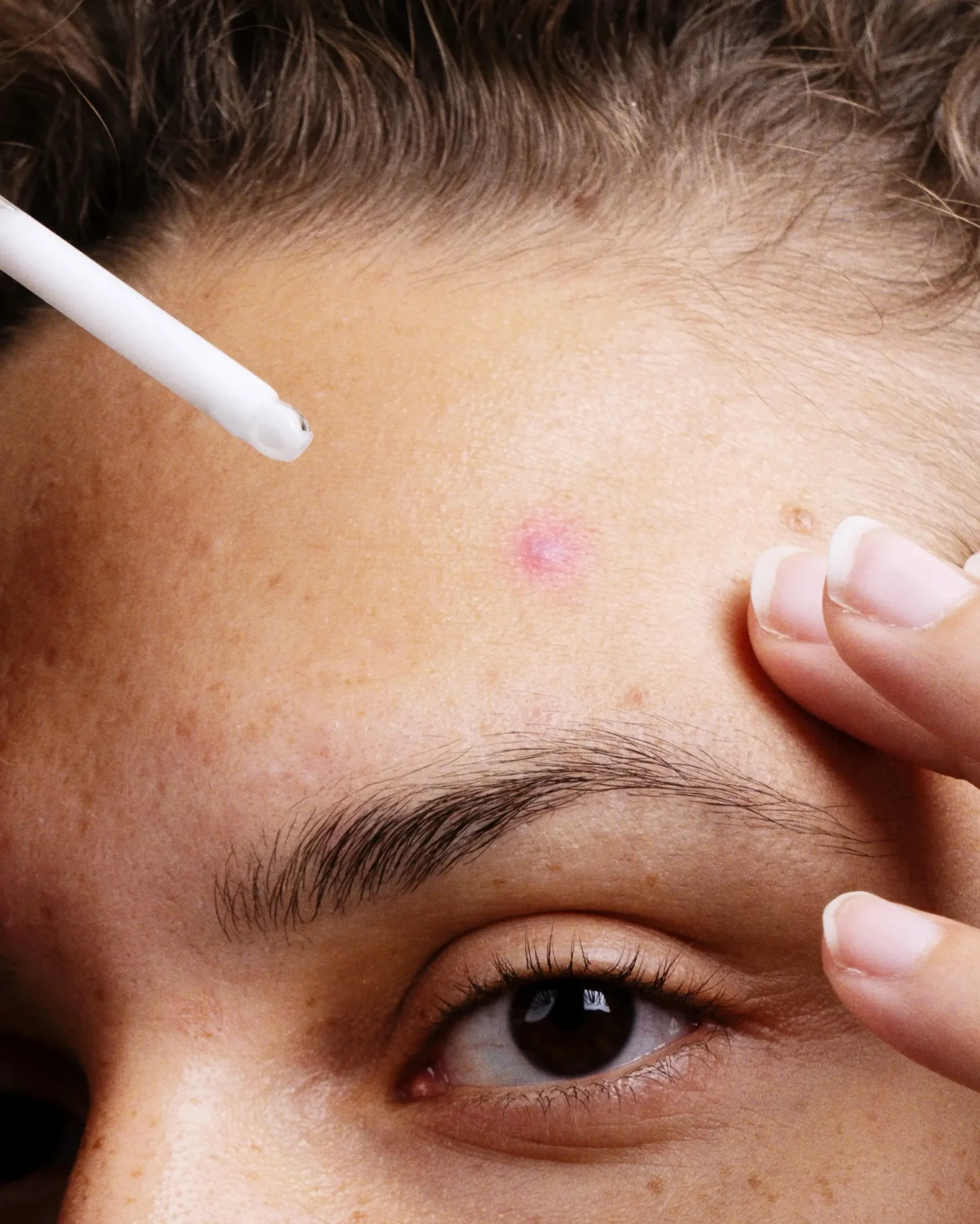 Hilft Niacinamid gegen Akne?